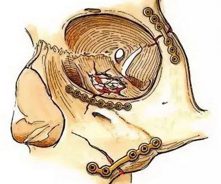 Fracturi ale osului zigomatic si simptomele arcada zigomatică, diagnostic, tratament și primul ajutor