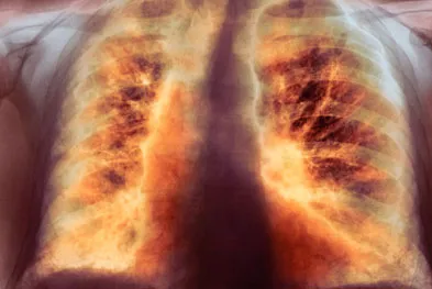 Tüdőfibrózis és annak kezelése népi jogorvoslati