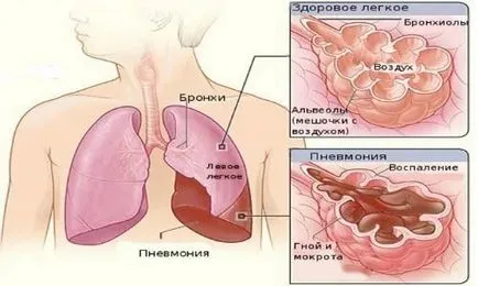 Пневмония - методите за лечение и профилактика