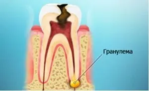 Лікування гранульоми зуба антибіотиками і народними засобами в домашніх умовах (лікування гранульоми зуба народними засобами) Лікування гранульоми зуба антибіотиками і народними засобами в домашніх умовах