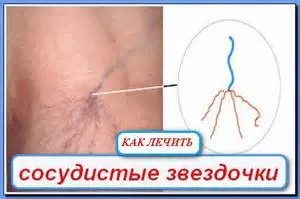 Лікування народними засобами судинні зірочки (судинні) Лікування народними засобами судинні зірочки
