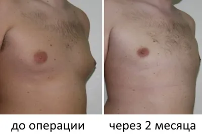 Лікування гінекомастії у чоловіків хірургічкеское (операція) і консервативне (без операції), ціна (гинекомастии) Лікування гінекомастії у чоловіків хірургічкеское (операція) і консервативне (без операції), ціна