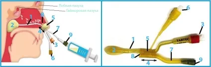 Лікування гаймориту синус-катетером ЯМІК відео, фото, відгуки (ЯМІК) Лікування гаймориту синус-катетером ЯМІК відео, фото, відгуки