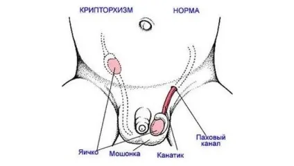 Лікування помилкового крипторхізму у дітей (лікування) Лікування помилкового крипторхізму у дітей