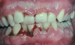 Indikációk és technikája gingivectomy; szövődmények ár