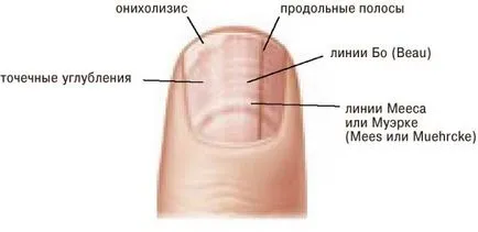 Ивици по ноктите, на причините и лечения