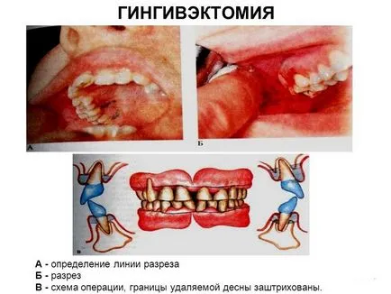 Indikációk és technikája gingivectomy; szövődmények ár