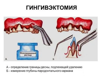 Indicații și tehnica gingivoplastia; preț complicații