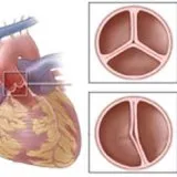 Szívbetegség kéthegyű aortabillentyű - kezelőorvosát Aibolit