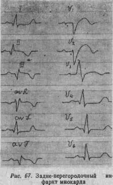 Kézi EKG (tankönyv) - dekódolása EKG