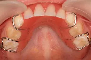dinți de lapte Proteza