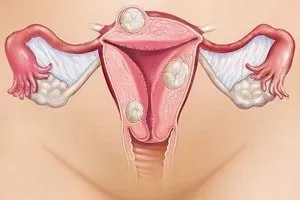 Anti gyertya endometriosis nőgyógyászati ​​- az életem