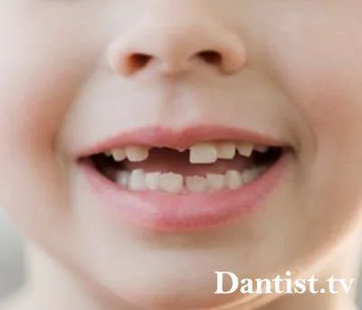 Протезиране първични зъби при децата на цените, видове и снимки