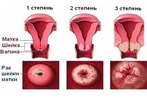 Ракът на маточната шийка в девствени причинява лечението