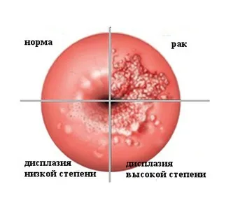 Маточната етап рак, симптоми, причини, диагностика и лечение на рак на маточната шийка