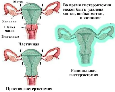 Маточната етап рак, симптоми, причини, диагностика и лечение на рак на маточната шийка