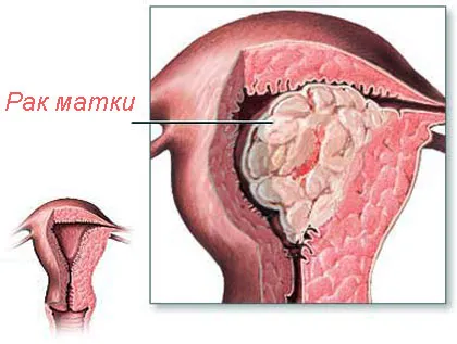 Ракът на маточната шийка в девствени причинява лечението