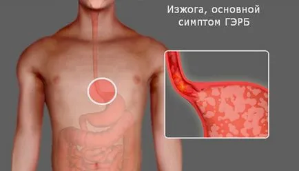Simptomele bolii de reflux gastro-esofagian, tratament si dieta pentru GERD
