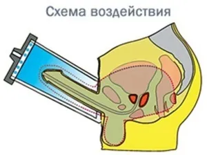 Лод-терапія, суть і показання до застосування