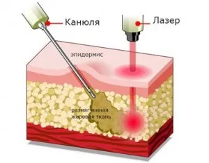 Ліпосакція способи проведення процедури