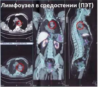 Лімфатична система при онкозахворюваннях (система) Лімфатична система при онкозахворюваннях