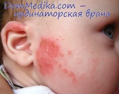 Лікарські засоби викликають алергію (ознаки алергії на ліки) Лікарські засоби викликають алергію