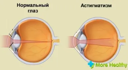 Лікування складного гиперметропического астигматизму обох очей у дітей деякі причини (лікування) Лікування складного гиперметропического астигматизму обох очей у дітей деякі причини