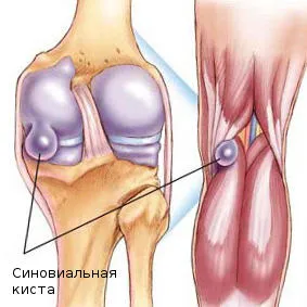 синовиална киста