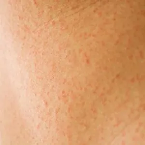 Simptomele de alergii la bifidumbacterin - totul despre alergie