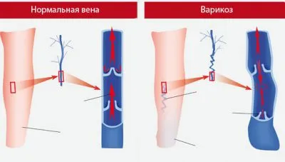 Симптомите на разширени вени симптоми, как да се определят и как да проявяват разширени вени