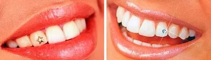 Skys на зъбите - какво е това, видове монтаж, цена - д-р зъб