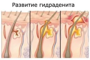 Aureus за лечение на лицето и методи за предотвратяване