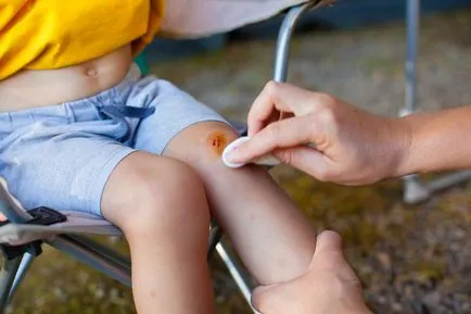 Horzsolások és zúzódások a baba elsősegély