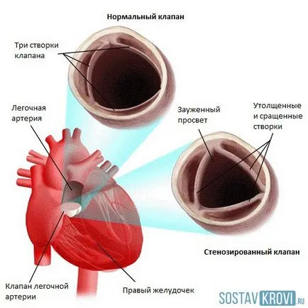 Белодробна стеноза при новородени, деца, възрастни, прогнозата, причини и лечение