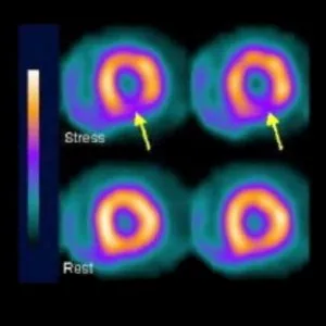 Szívizom-szcintigráfia (szív), amely, a terhelés és nyugalmi