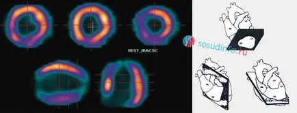 Szívizom-szcintigráfia (szív), amely, a terhelés és nyugalmi