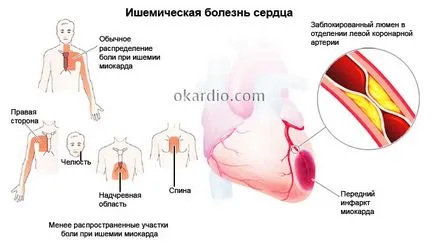 миокардни проучвания сцинтиграфия са като преминава, доказателства