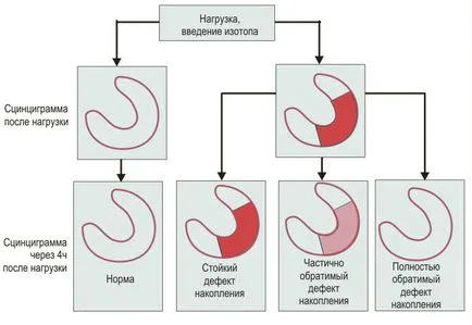 Szívizom-szcintigráfia (szív), amely, a terhelés és nyugalmi