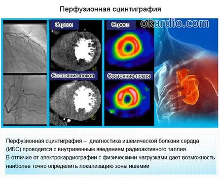 Studiile scintigrafie miocardică sunt pe măsură ce trece, dovezi