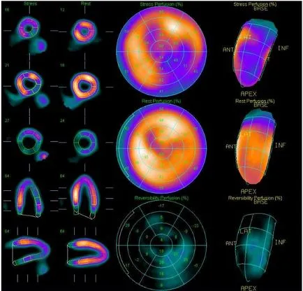 Szívizom-szcintigráfia (szív), amely, a terhelés és nyugalmi