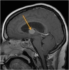 norma Thalamocele și patologie