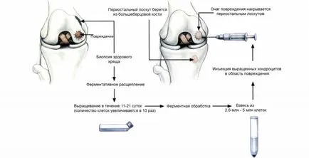 хондроцитаната трансплантация