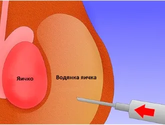 Премахване на хидроцеле и последствия след операция