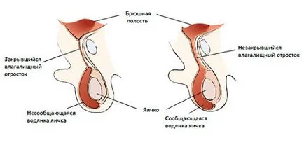 Премахване на хидроцеле и последствия след операция