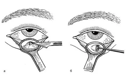 Премахване на Chalazion хирургия и грижи в следоперативния период