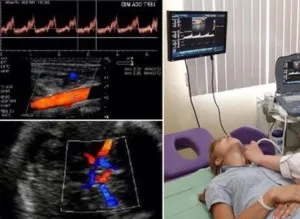 Doppler ultrahang a nyak hajók, amely megmutatja az eljárást, és hogy milyen funkciók