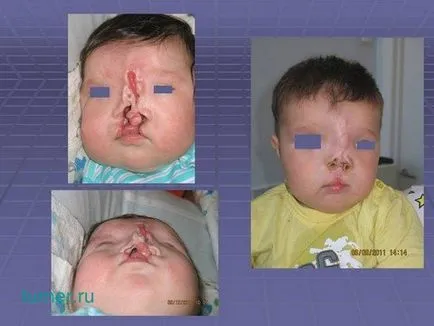 Műtéti kezelés és a rehabilitáció gyermekek ajak- szájpadhasadék