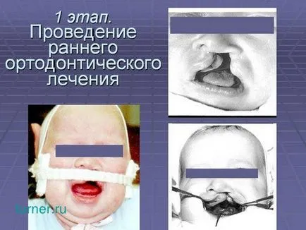 Tratamentul chirurgical și reabilitarea copiilor cu buza cleft si palatului