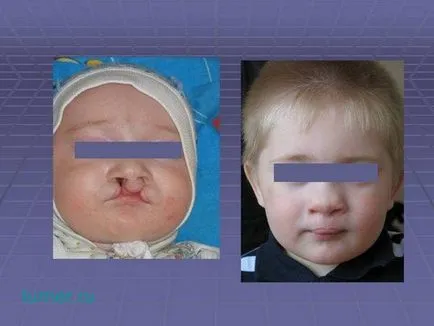Tratamentul chirurgical și reabilitarea copiilor cu buza cleft si palatului