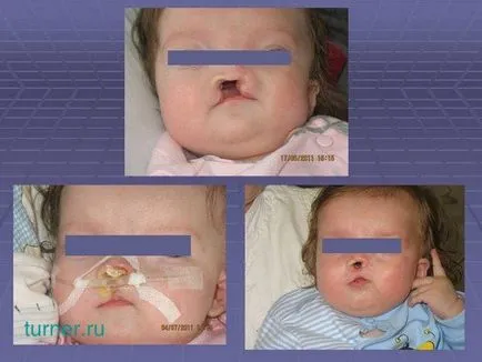 Műtéti kezelés és a rehabilitáció gyermekek ajak- szájpadhasadék
